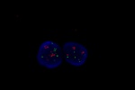 Neprav amplifikace genu Her-2/neu vyetenho sondou LSI Her-2/neu (Orange) a CEP17 (Green) - parafnov ez